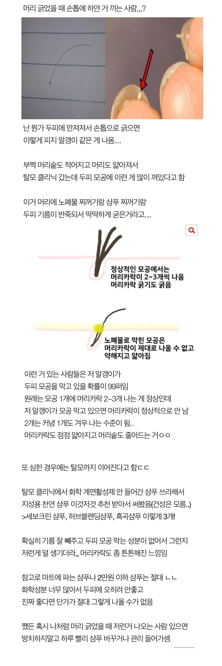 머리긁었을때 손톱에 하얀거 끼는사람???