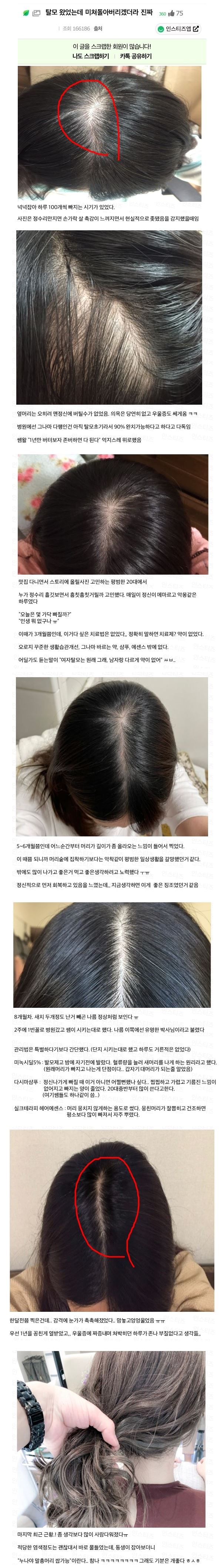 여성탈모 역변과정.jpg