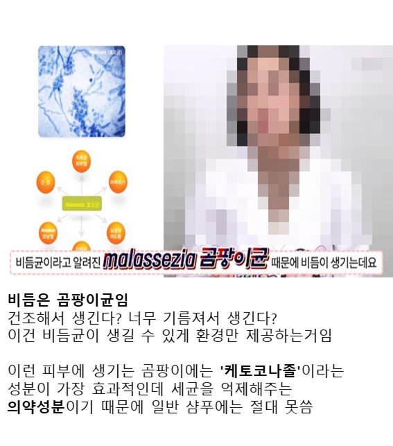 펌) 비듬샴푸 효과 1도 없음