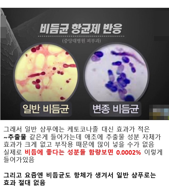 펌) 비듬샴푸 효과 1도 없음