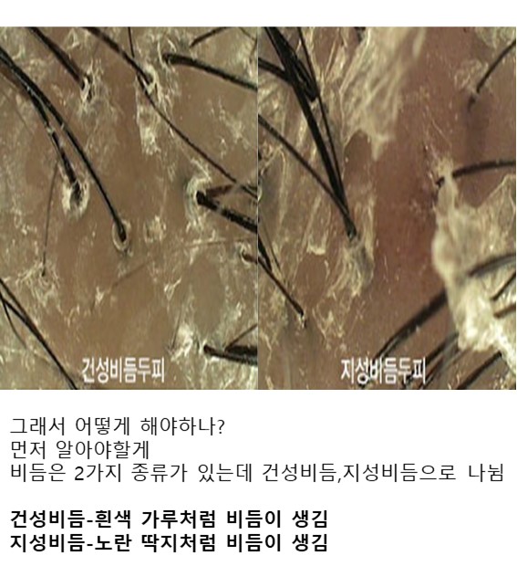 펌) 비듬샴푸 효과 1도 없음