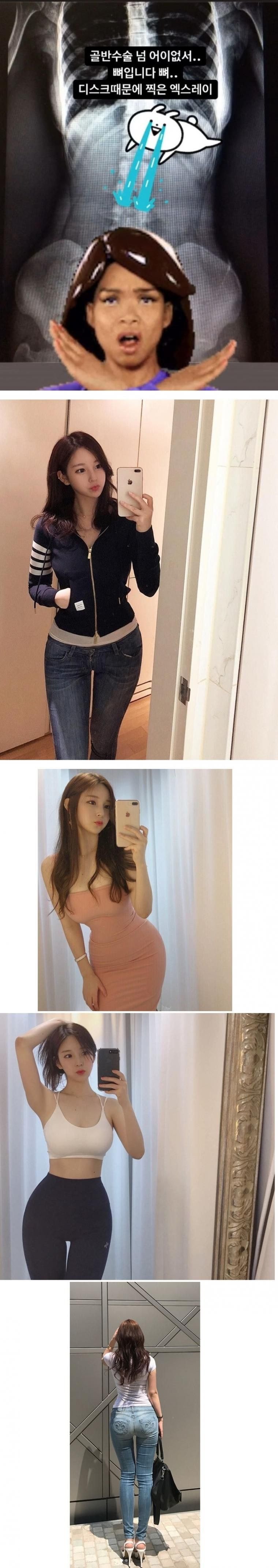 골반수술 루머?? 여신강림 작가님 X-ray