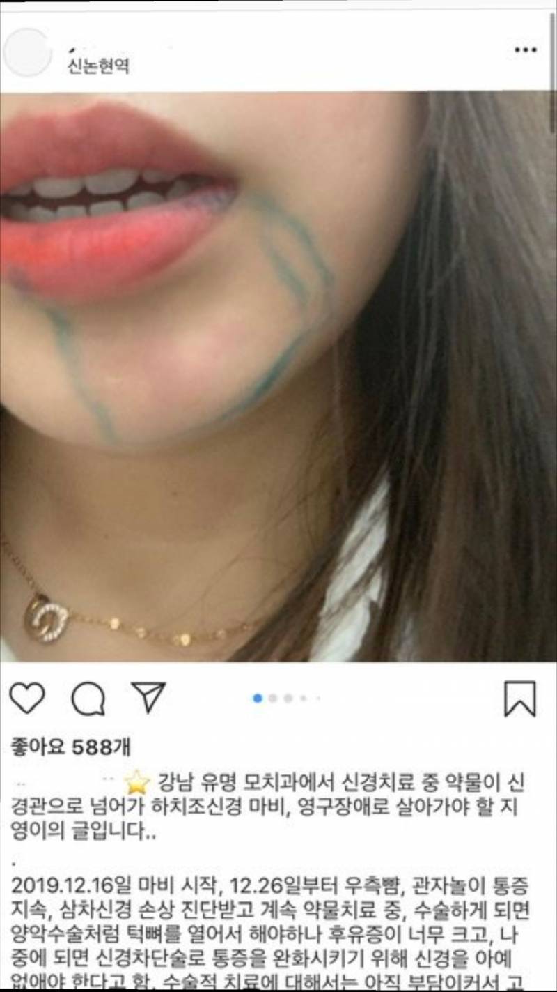 최근 인스타에서 난리난 치과 (신경치료 의료사고??)