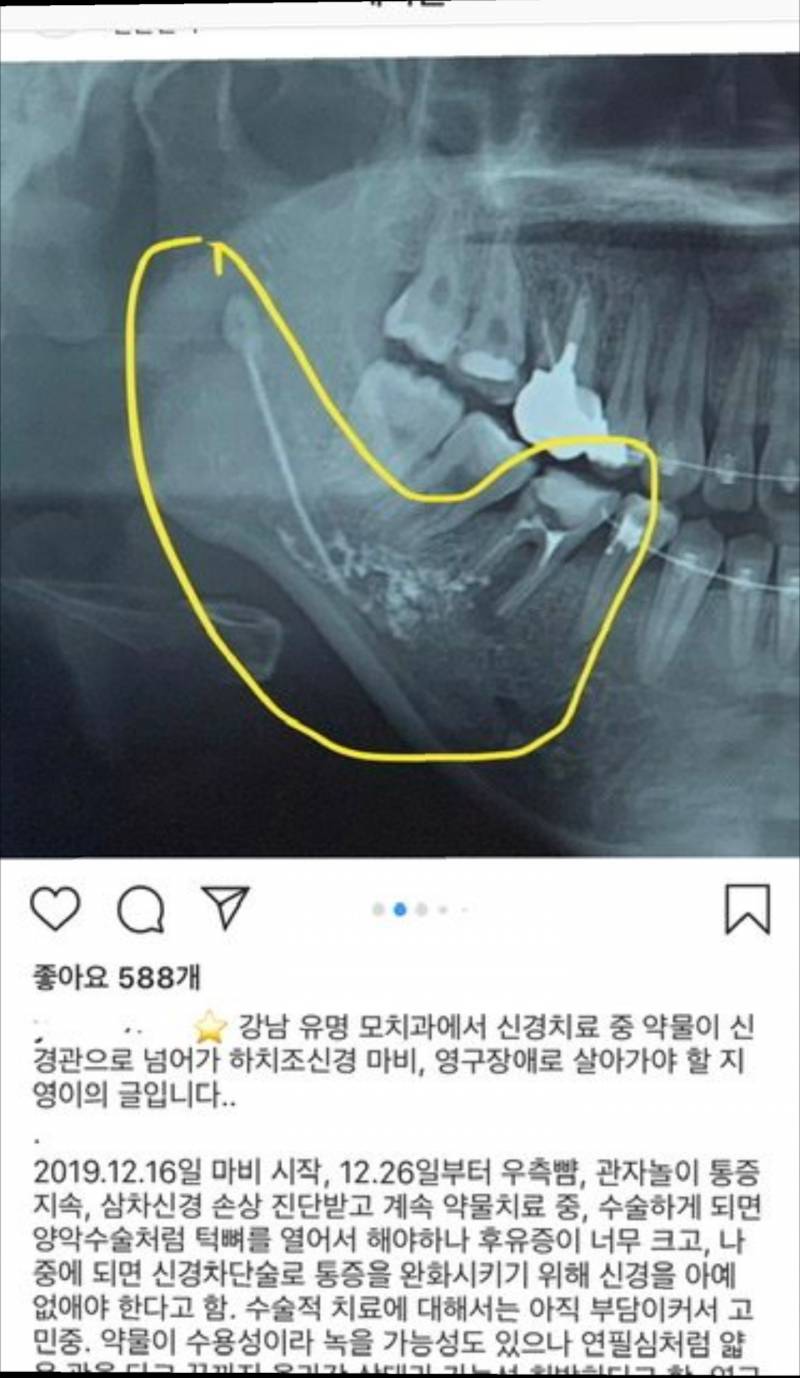 최근 인스타에서 난리난 치과 (신경치료 의료사고??)