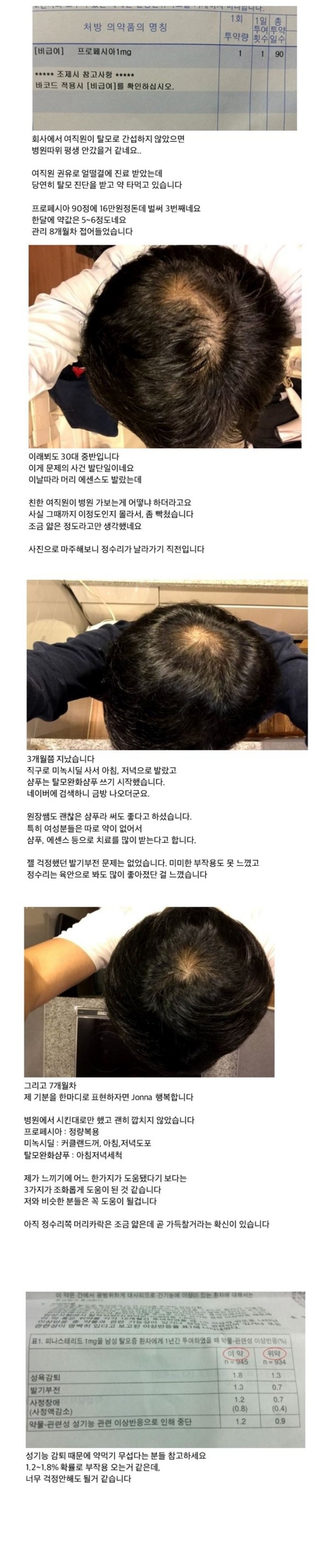 성기능 감퇴 없이 탈모 극복한 정수리 탈모인